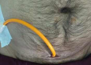 SPC (suprapubic catheter) for bladder care in the SCI persons?                             (Title 35)                                                                                    SCI व्यक्तियों में मूत्राशय की देखभाल के लिए सुप्राप्यूबिक कैथेटर?